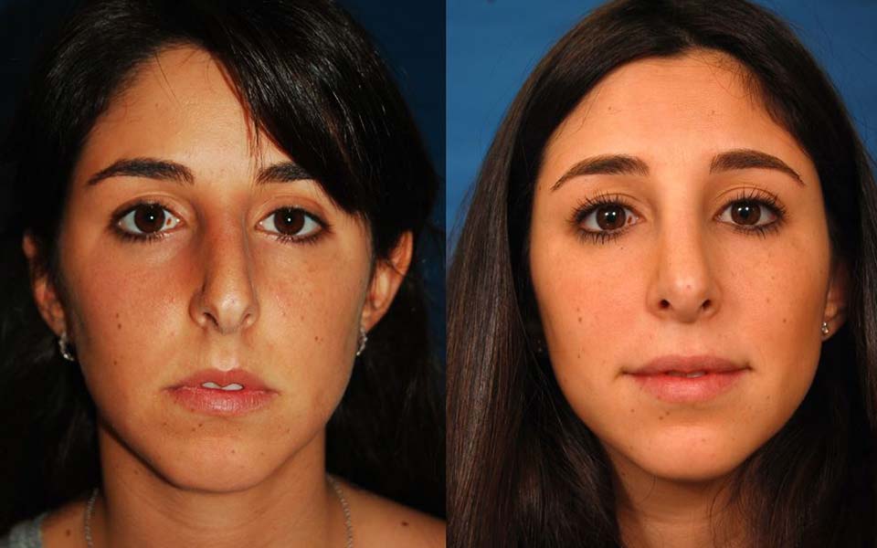 How much does a nose job cost?